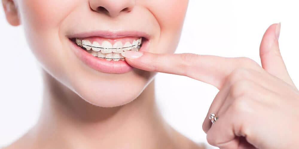 ds-dental-braces