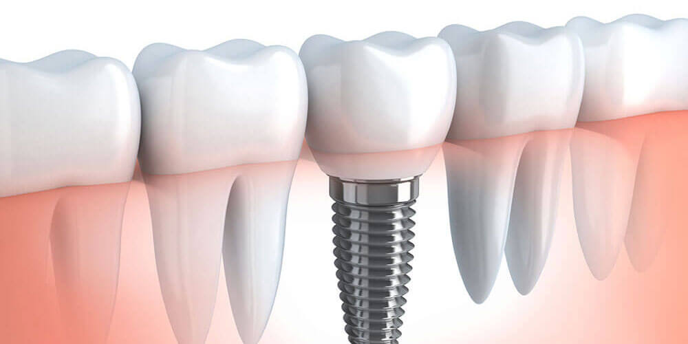 ds-dental-implants