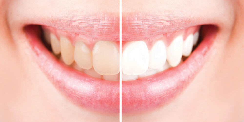 ds-teeth-whitening