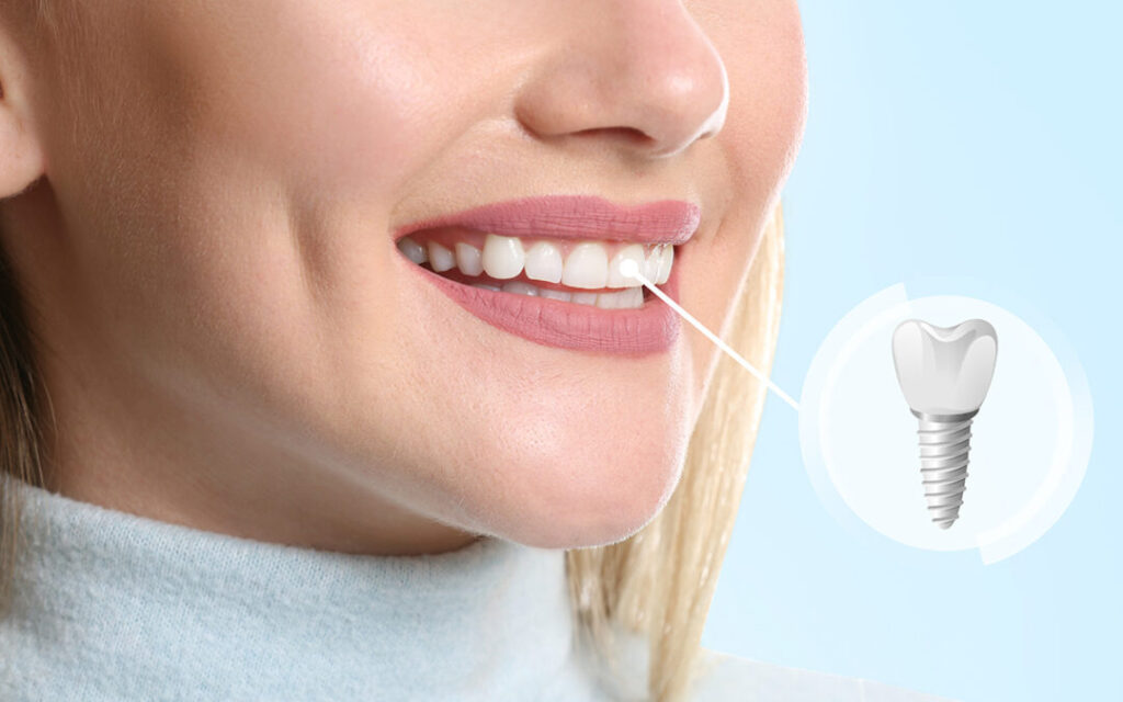 top quality dental implants service in vancouver